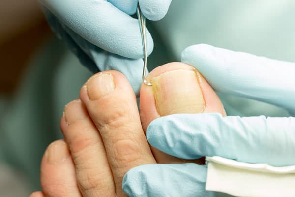 Hongos en las uñas de los pies