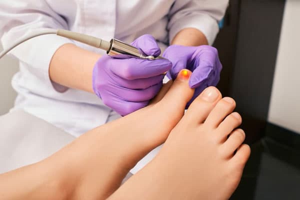 Láser podológico